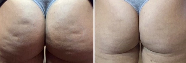 Tratamiento de celulitis en glúteos, antes y después