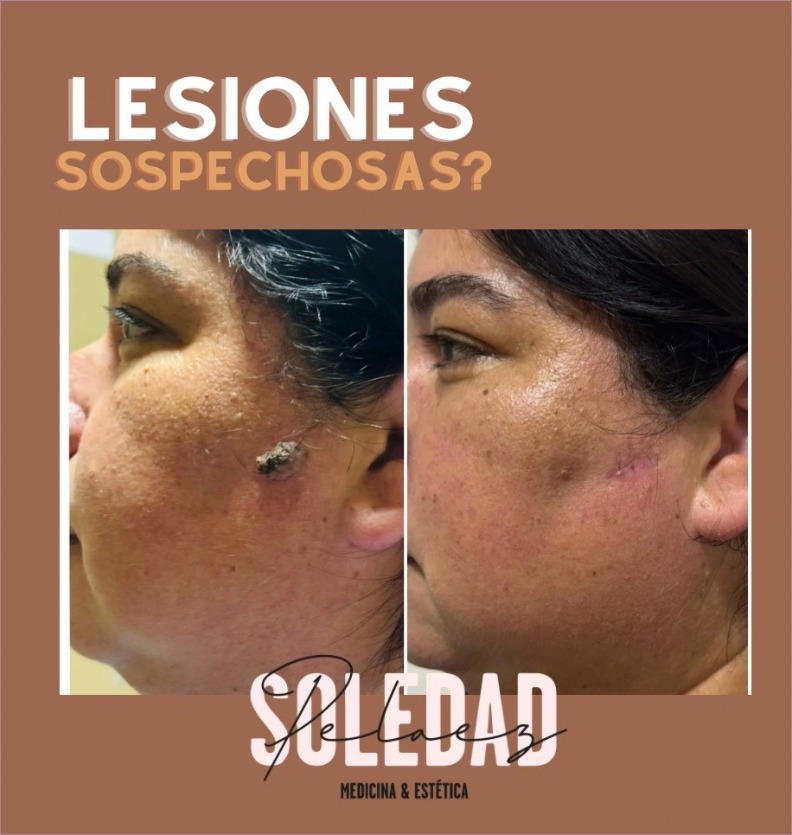 Lesiones sospechosas, antes y después de extracción