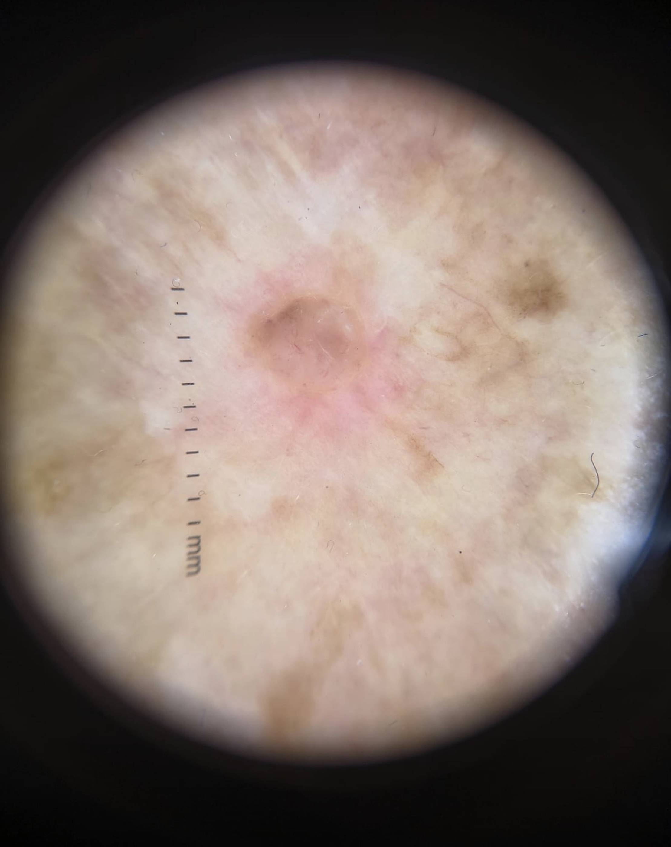 Análisis de lesión por dermatoscopia