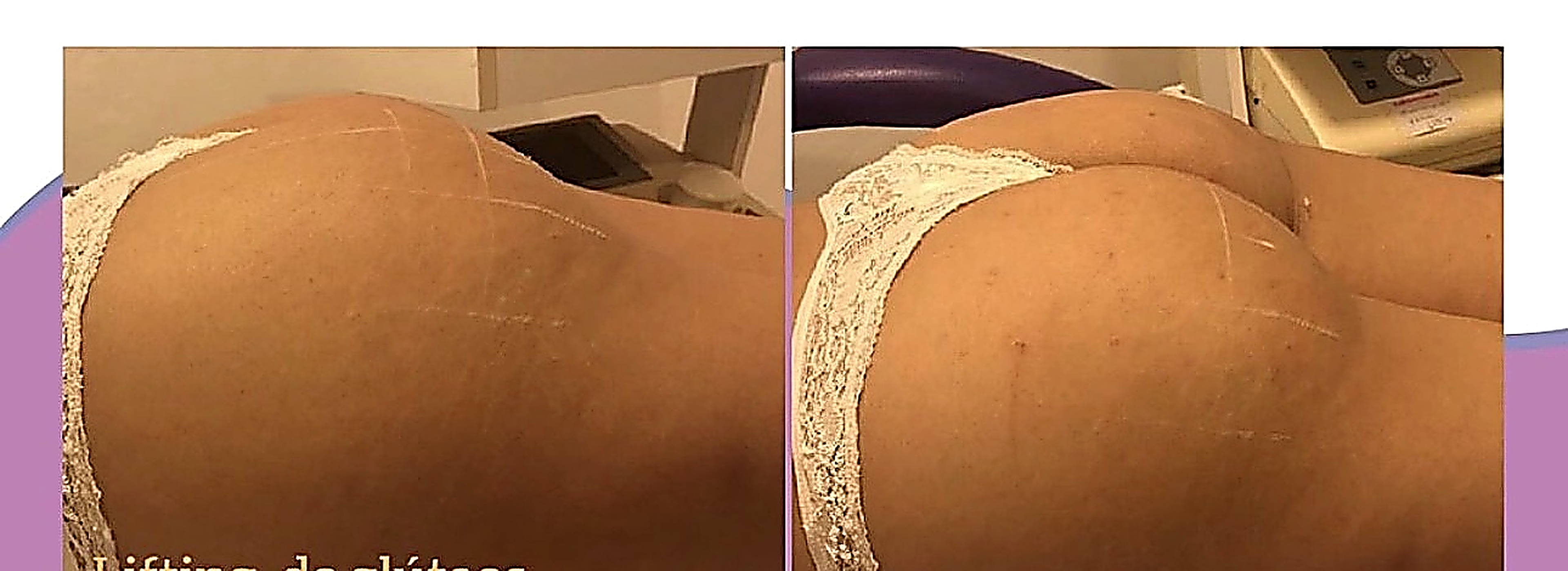 Lifting de glúteos, antes y después