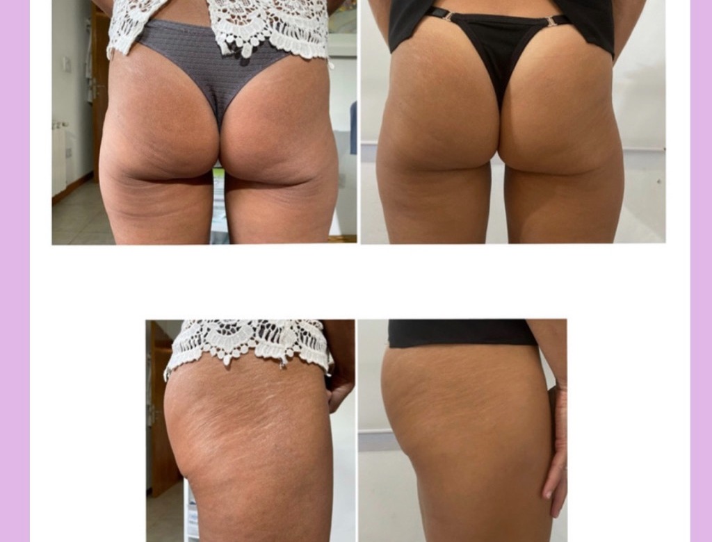 Lifting de glúteos, antes y después, distintos ángulos