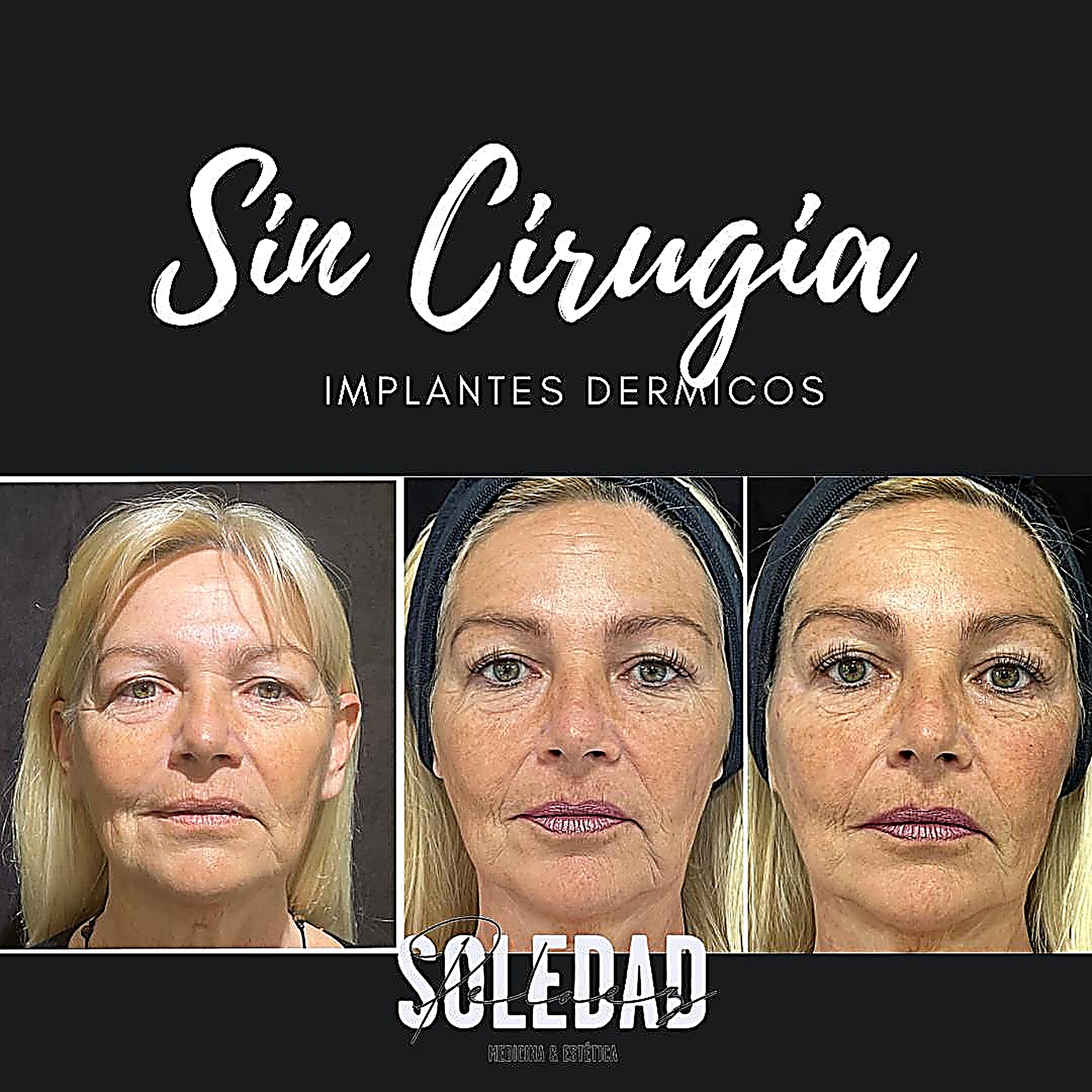 Implantes dérmicos sin cirugía, antes y después