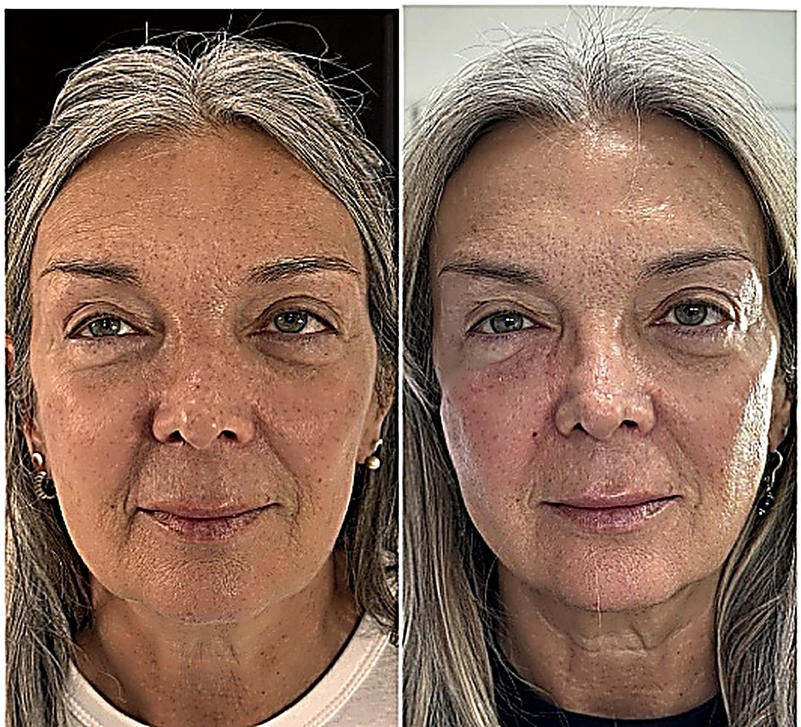 Rellenos dérmicos antes y después, rostro frontal