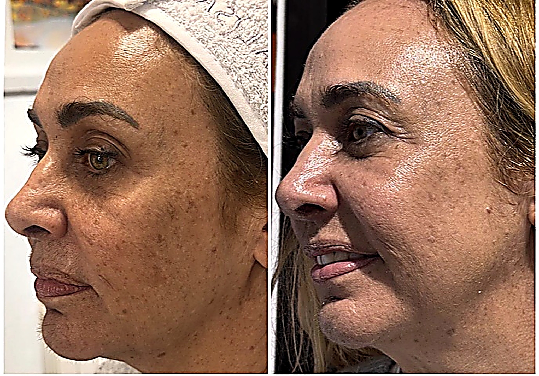 Tratamiento de manchas antes y después, perfil