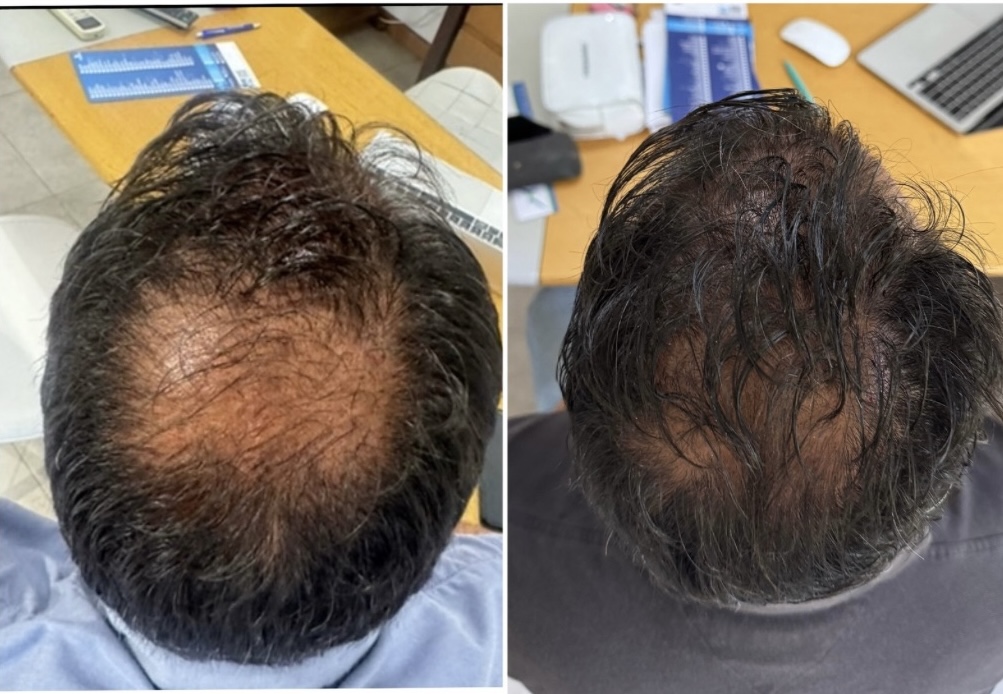 Mesoterapia capilar, zona frontal, antes y después