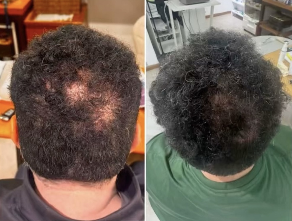 Mesoterapia capilar, zona posterior, antes y después