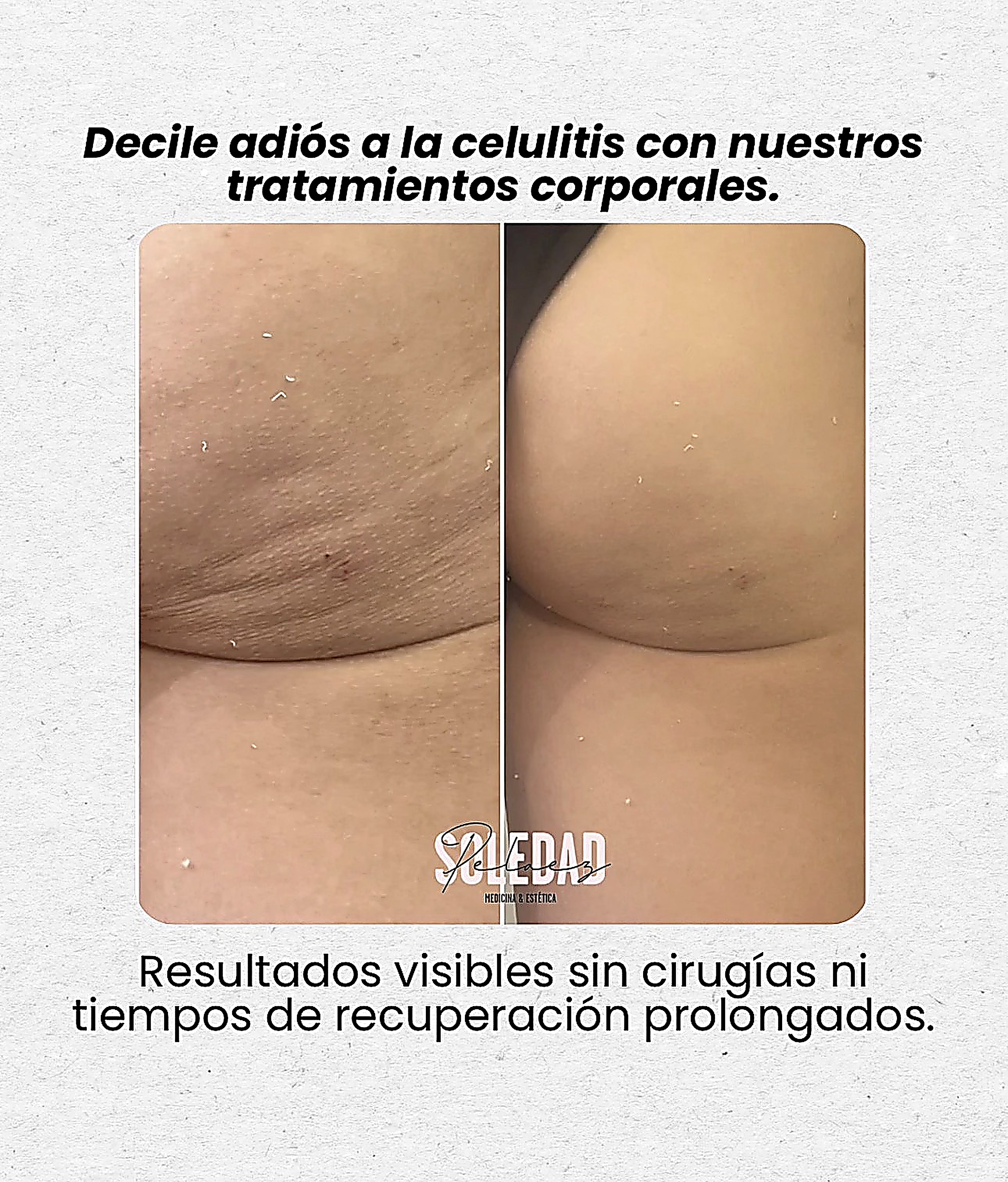 Tratamiento de celulitis antes y después