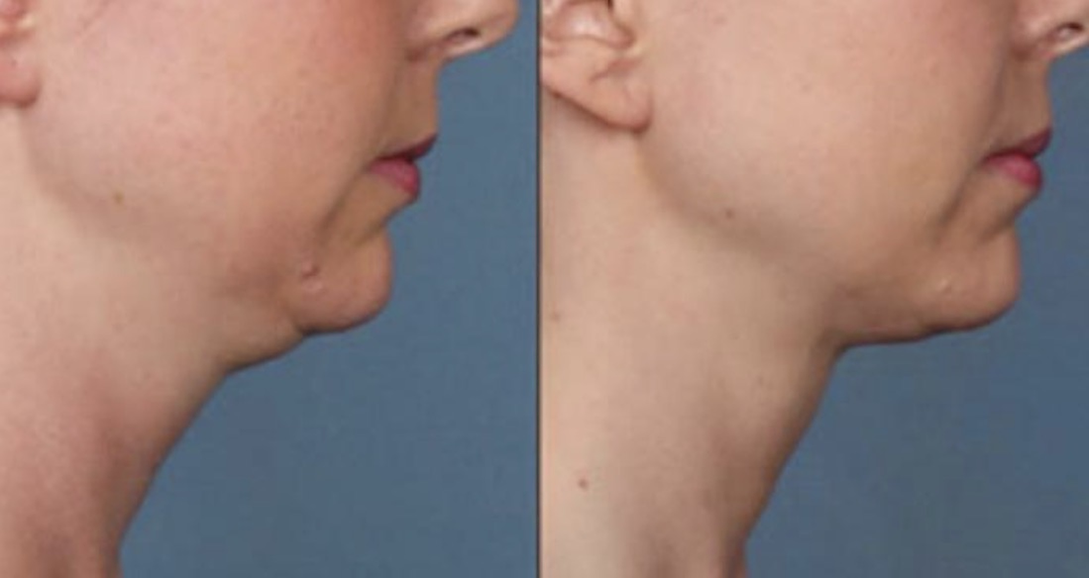 Reductor de papada, antes y después, perfil