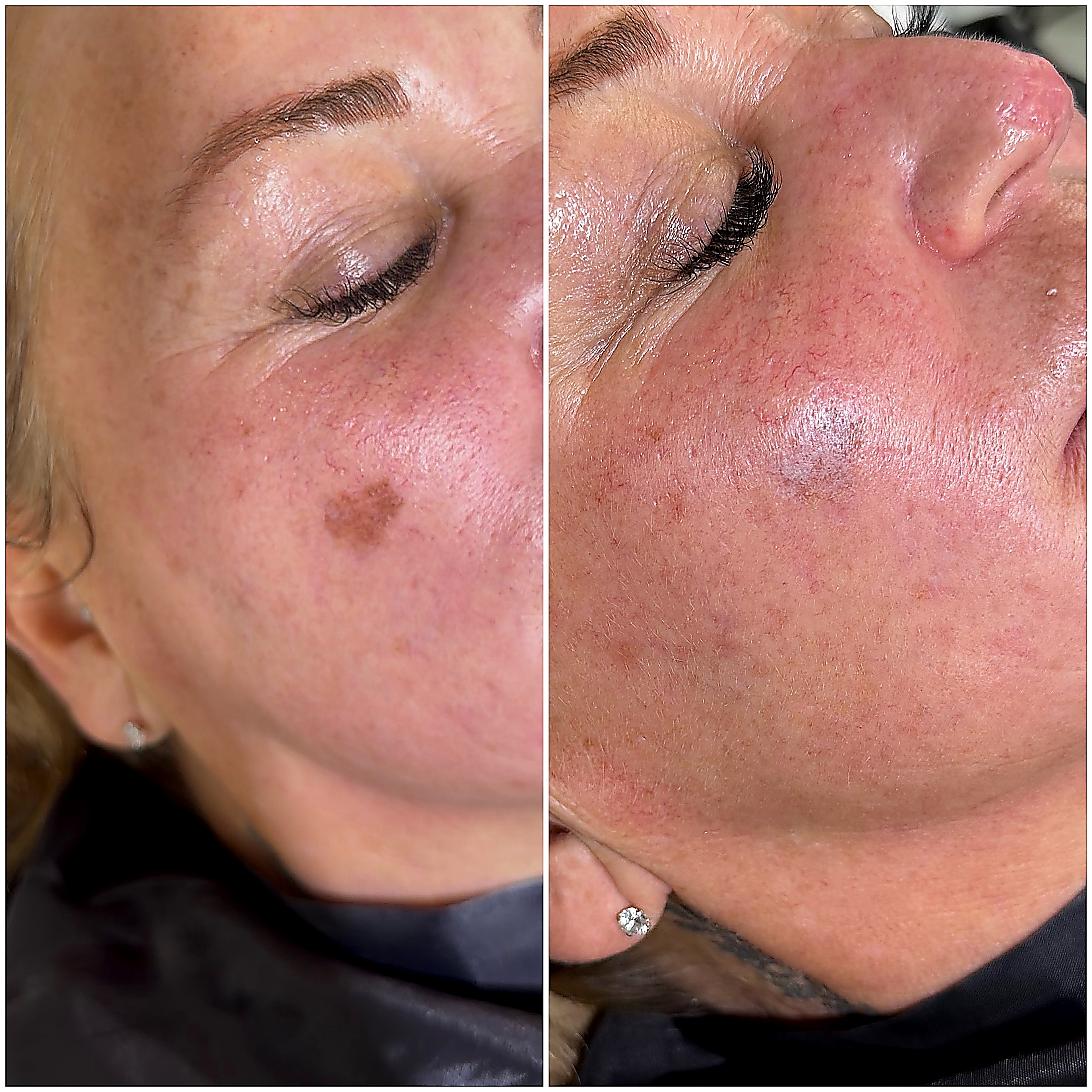 Peeling antes y después