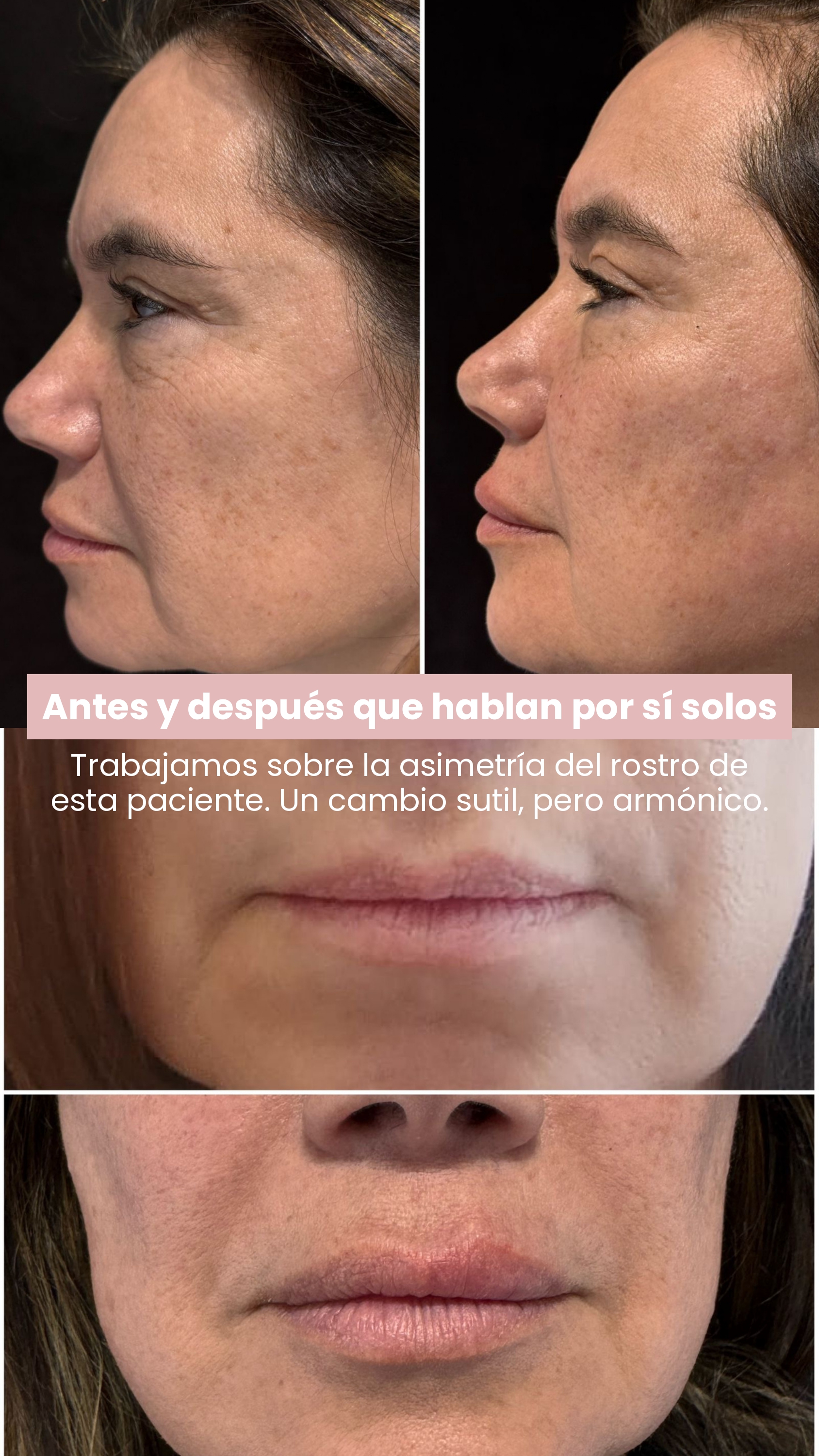 Relleno dérmico, corrección de asimetría facial, antes y después