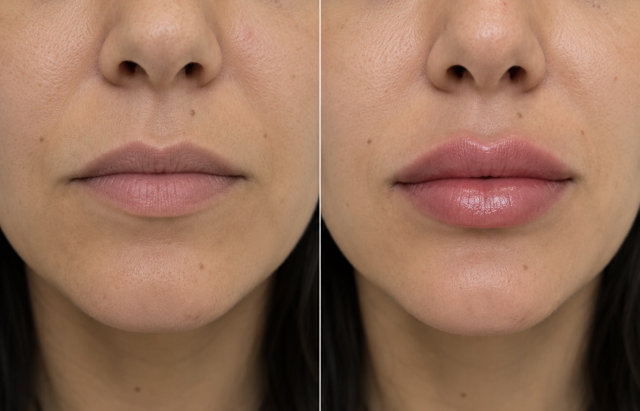 Relleno de labios, antes y después