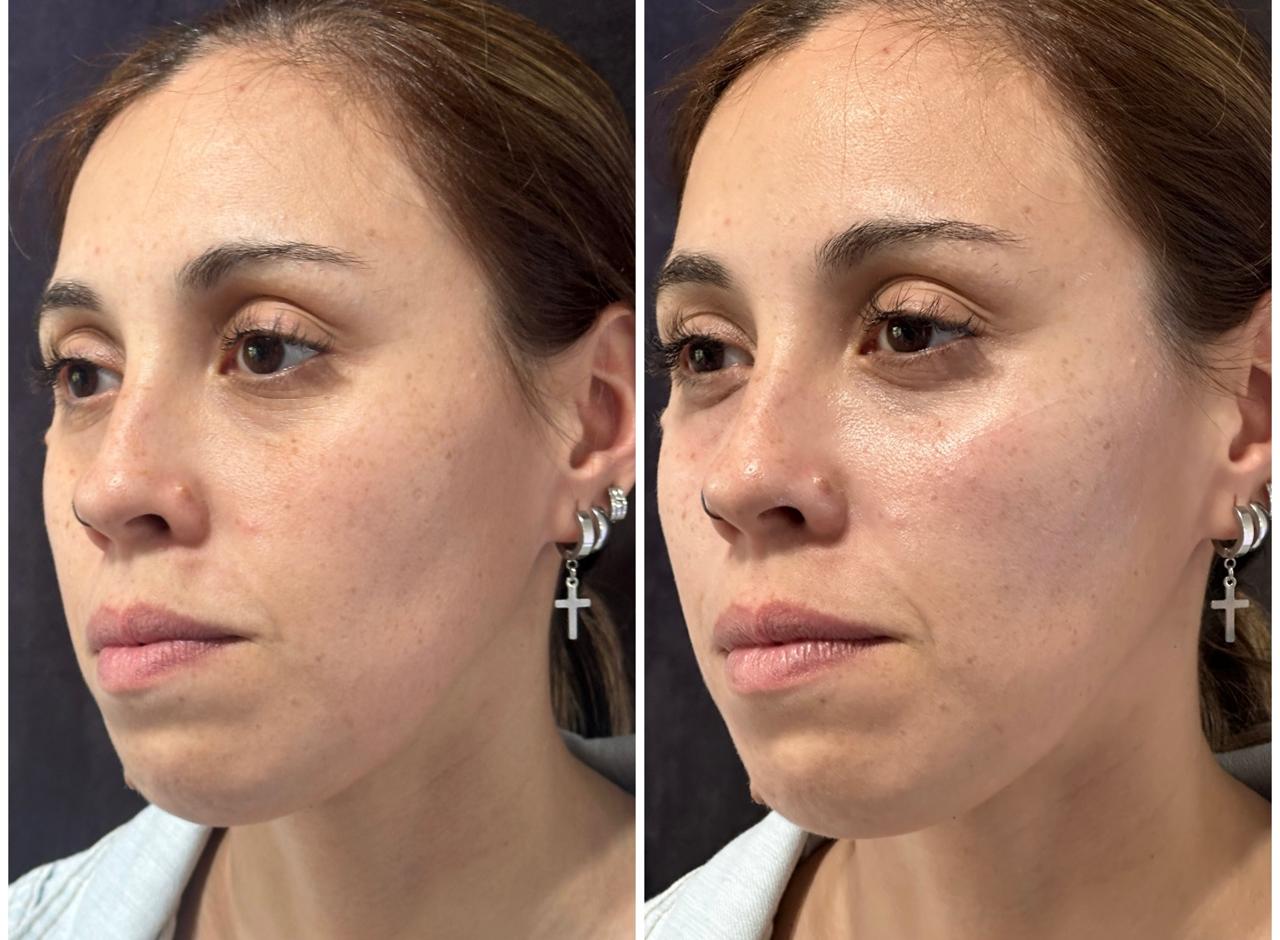 Relleno facial, perfil, antes y después