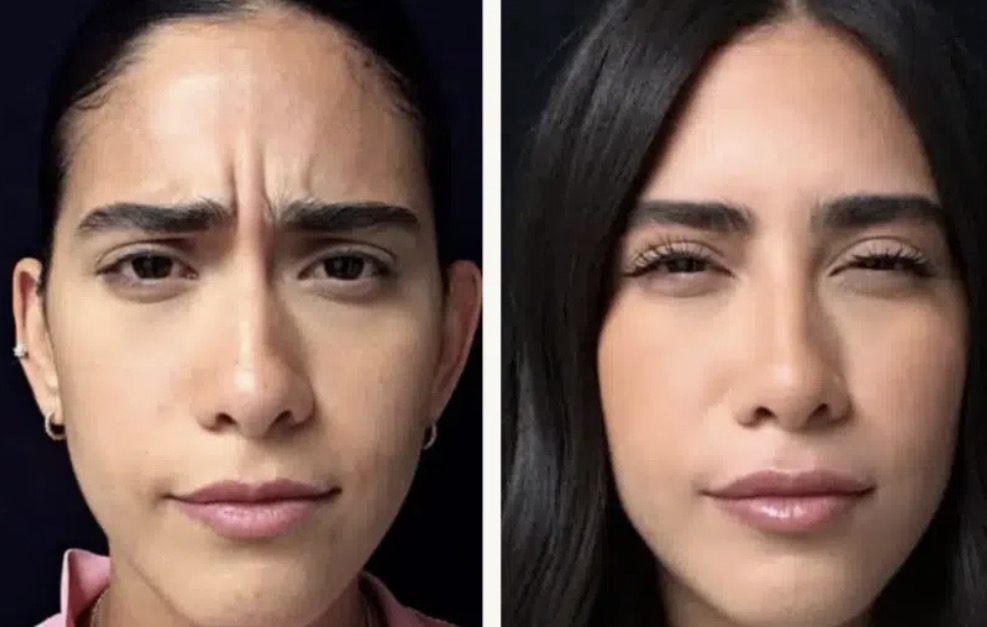 Toxina botulínica en frente, antes y después