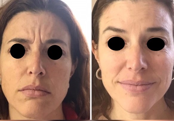 Frente, antes y después