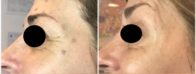 Contorno de ojos, antes y después