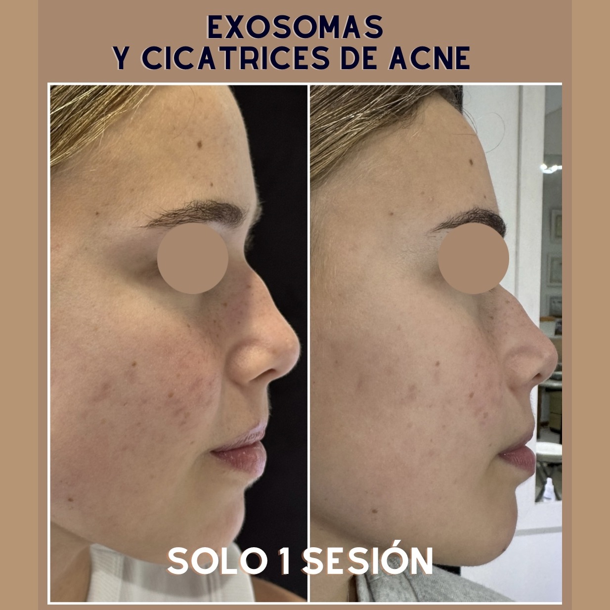 Exosomas y cicatrices de acné, antes y después