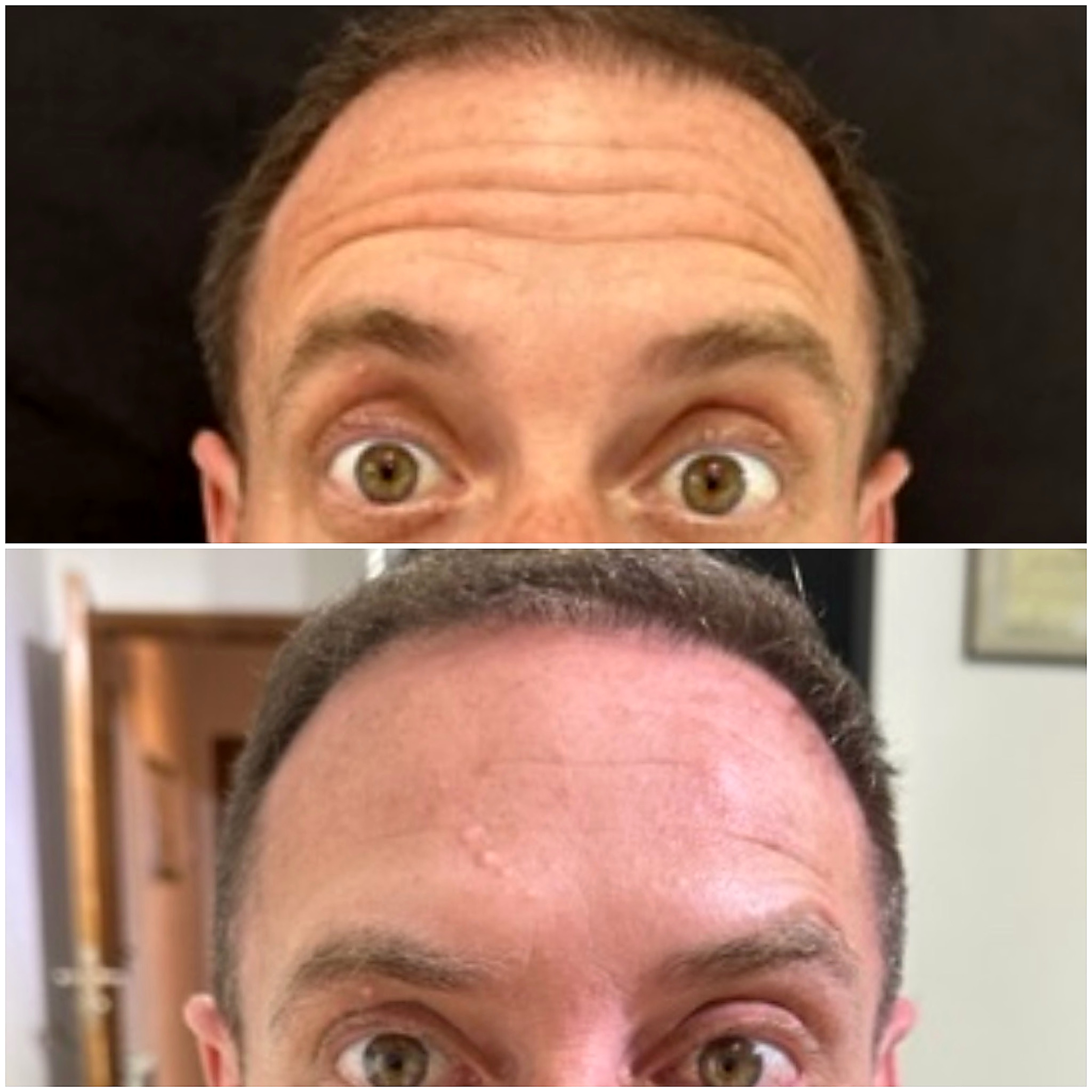Toxina botulínica en frente, antes y después