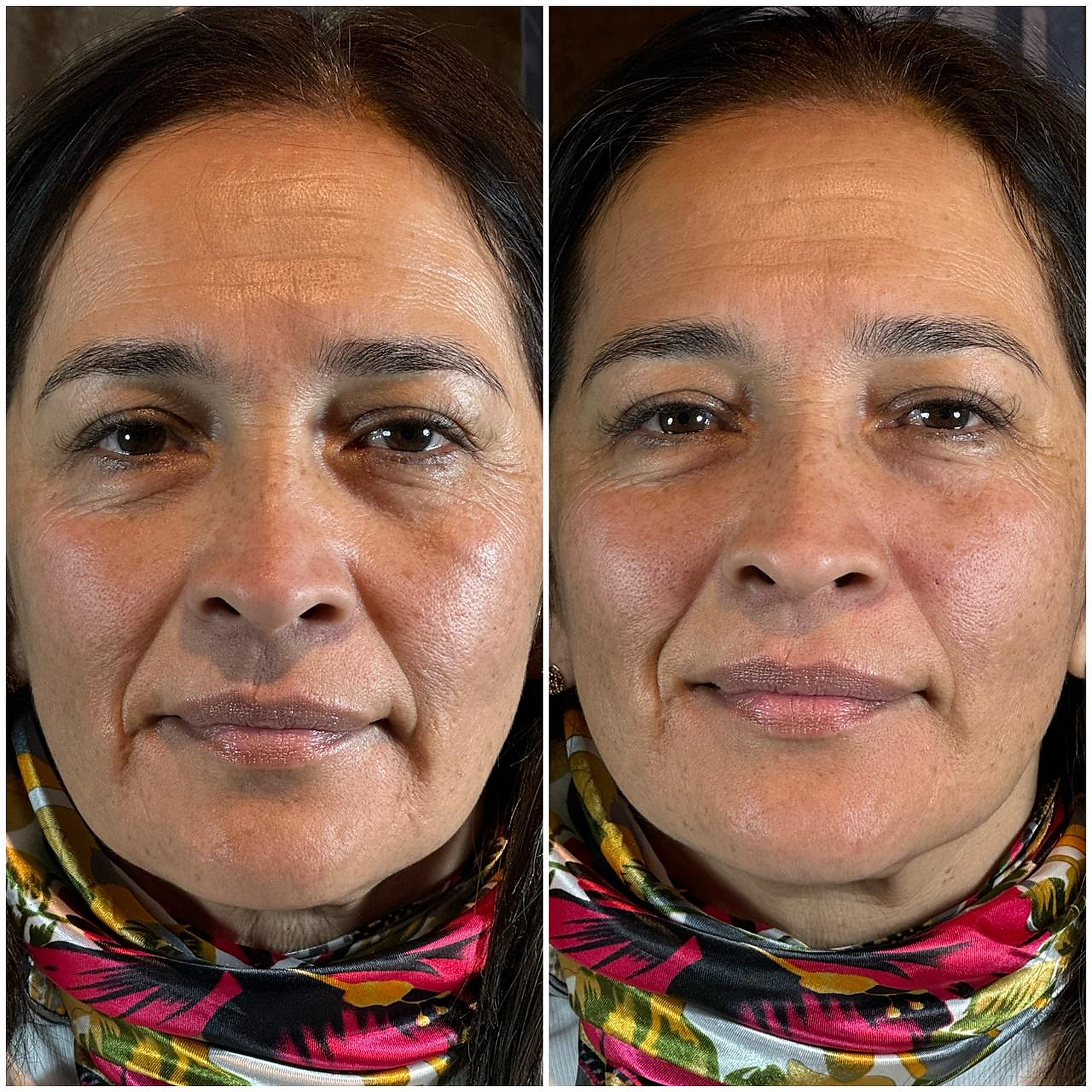 Rejuvenecimiento facial, antes y después