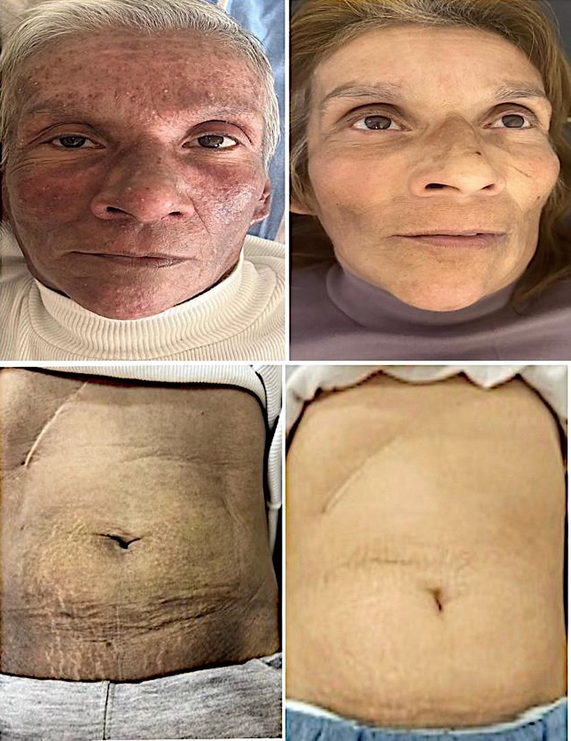 Rejuvenecimiento facial y abdominal, antes y después
