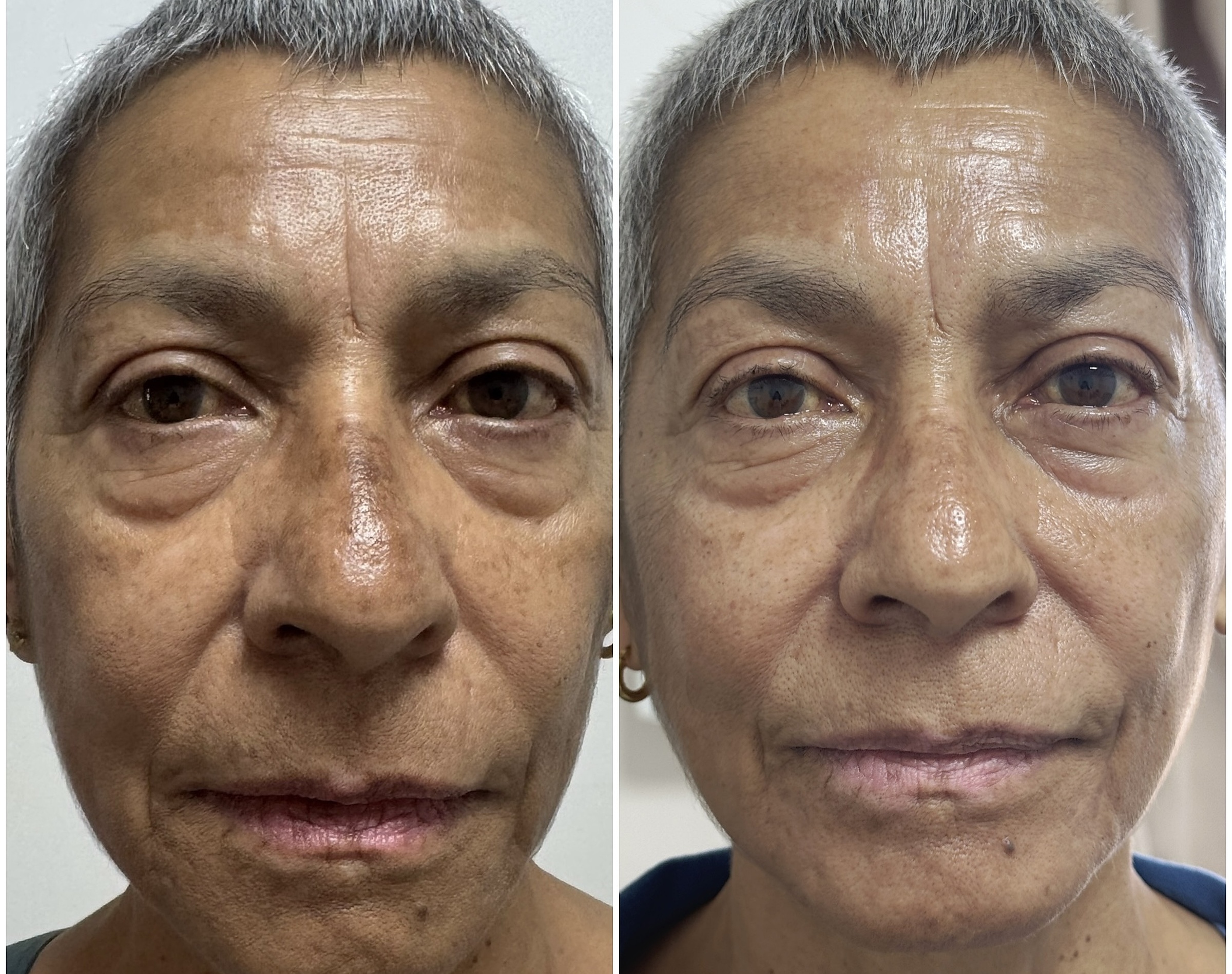 Rejuvenecimiento facial, antes y después