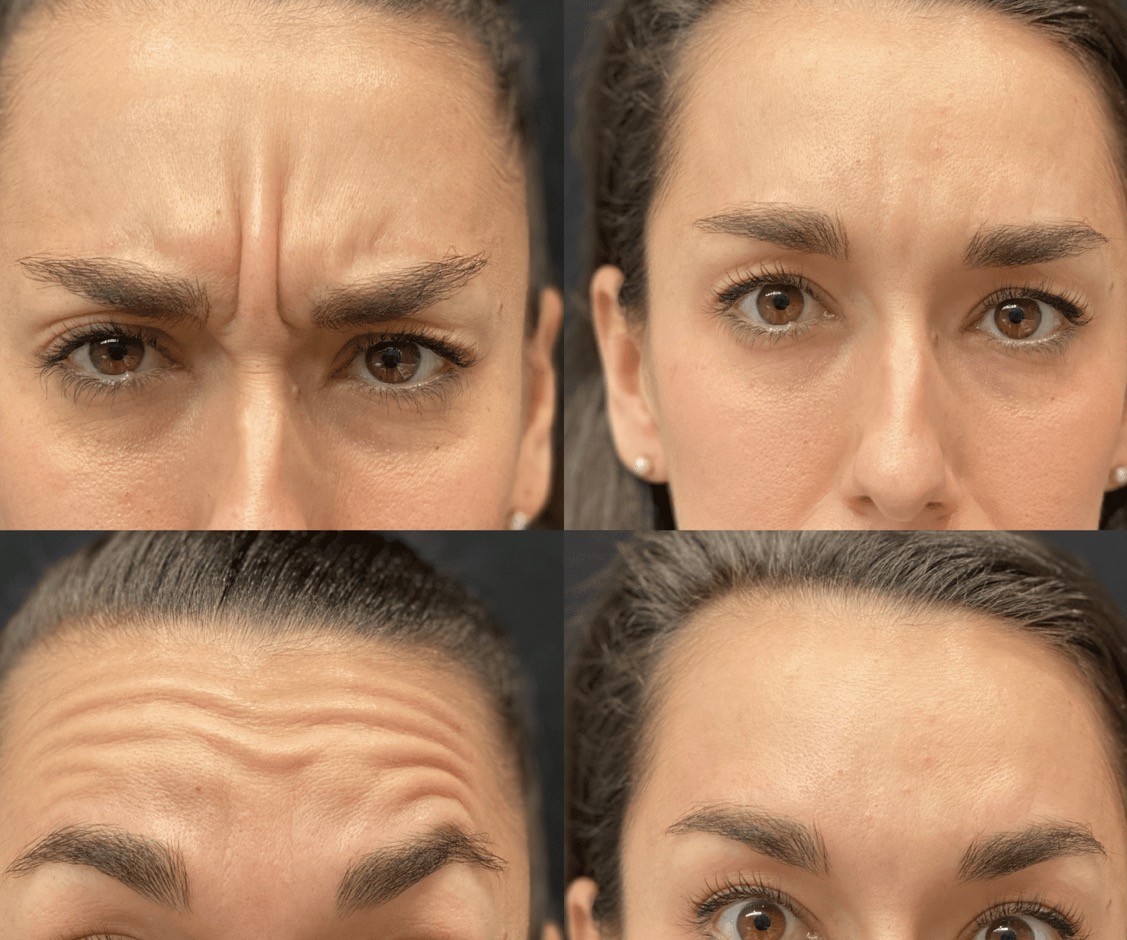Toxina botulínica en entrecejo, antes y después