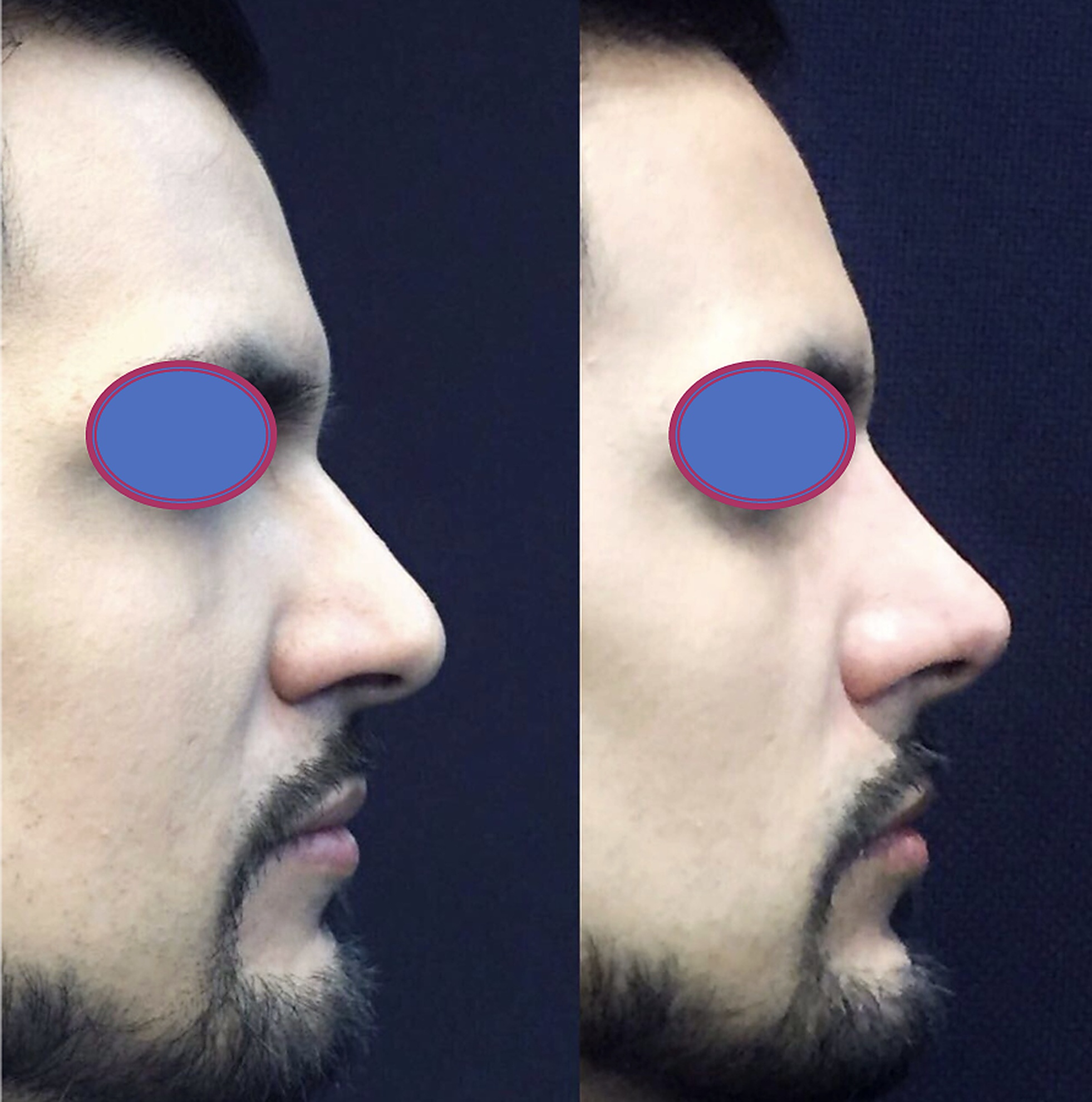 Rinomodelación, perfil, antes y después