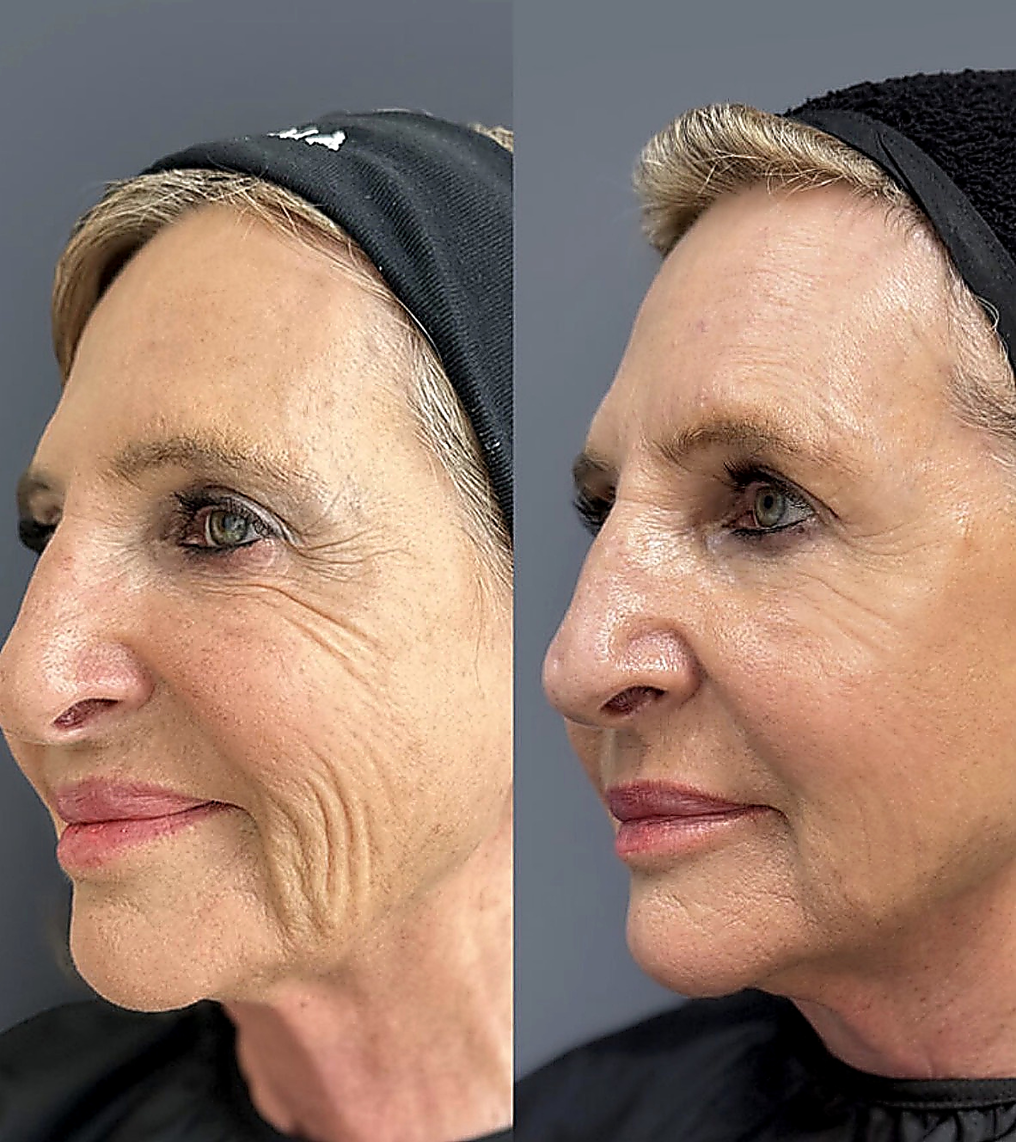 Sculptra antes y después, perfil