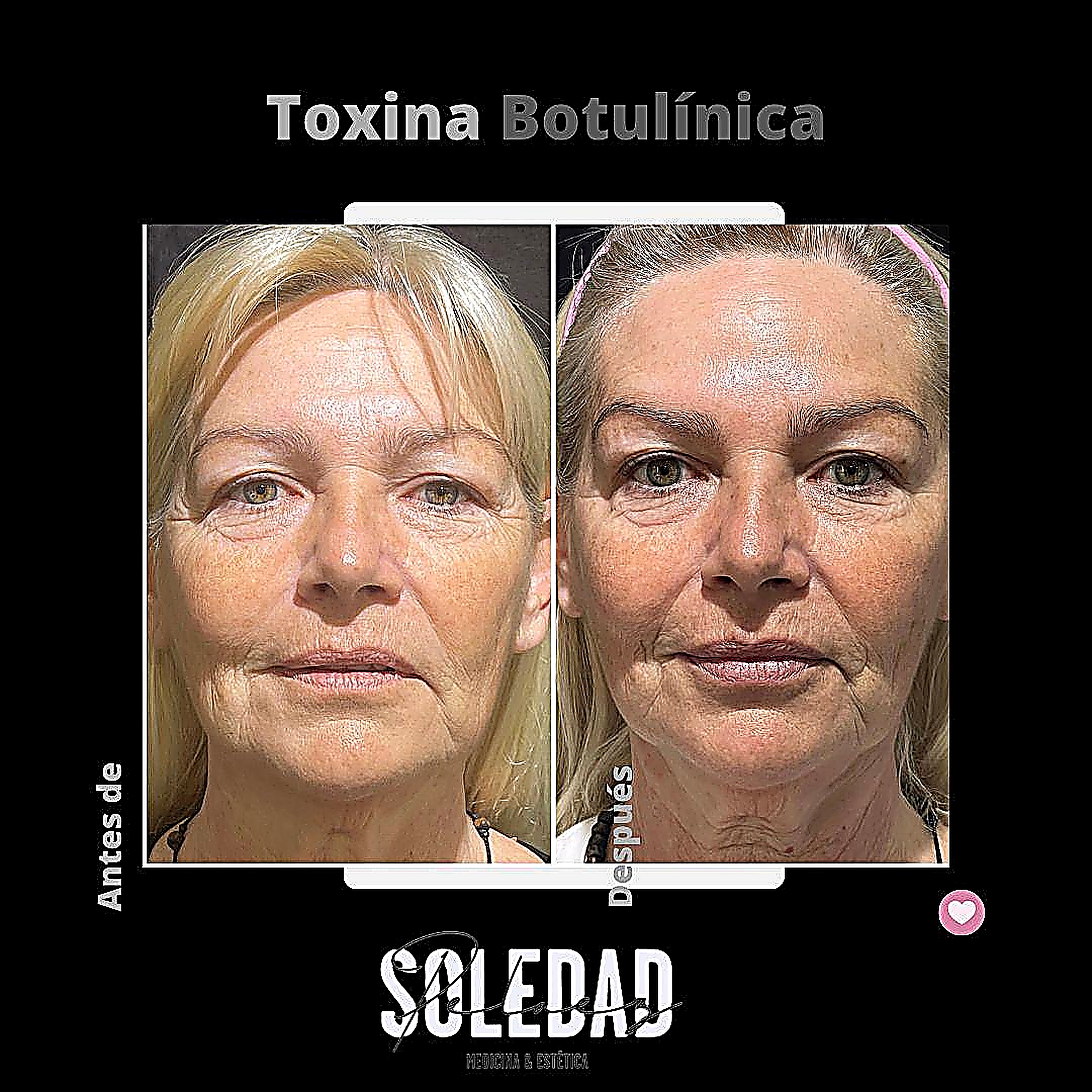 Toxina botulínica antes y después