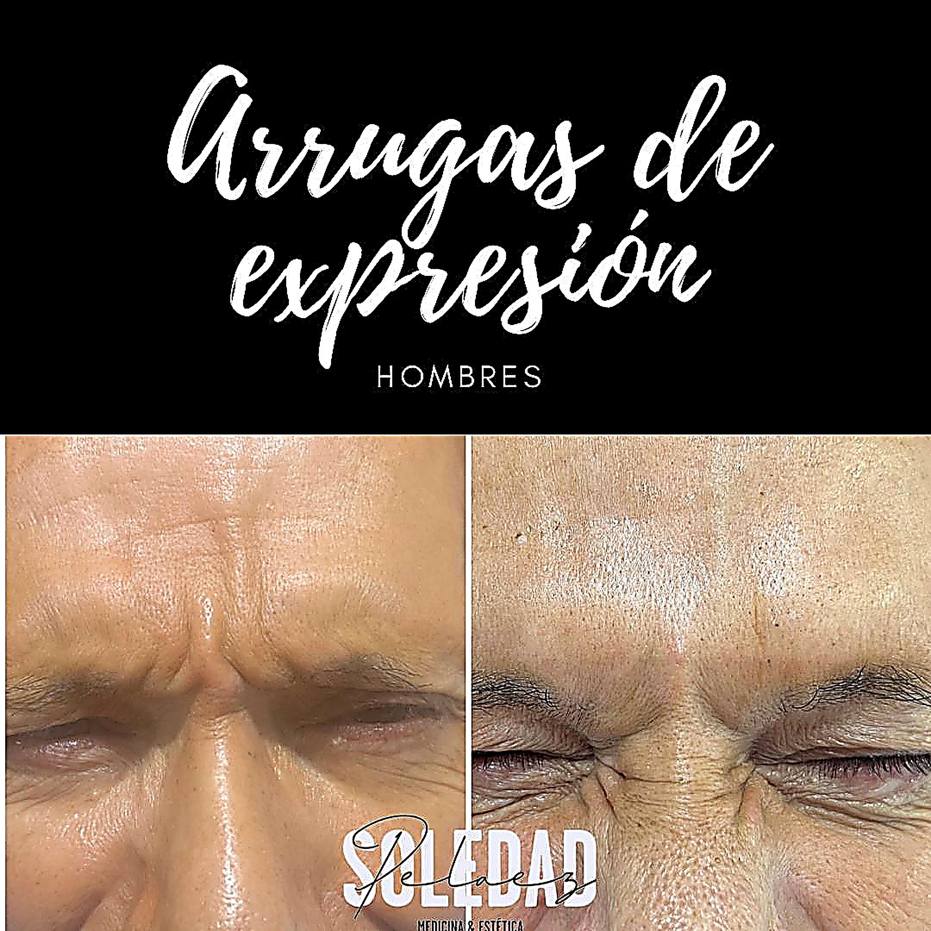 Arrugas de expresión en hombres, antes y después