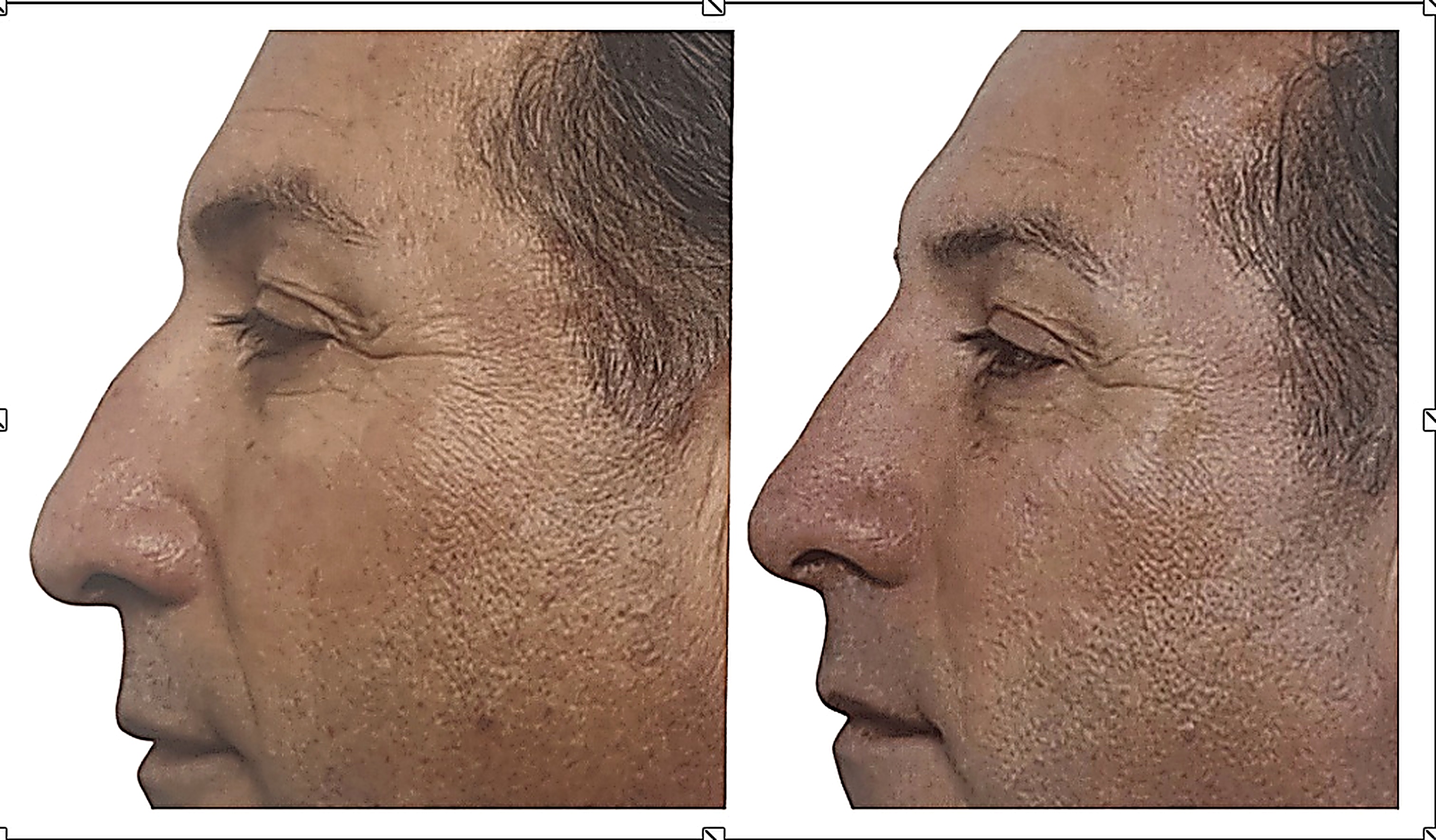 Rinomodelación, perfil, antes y después